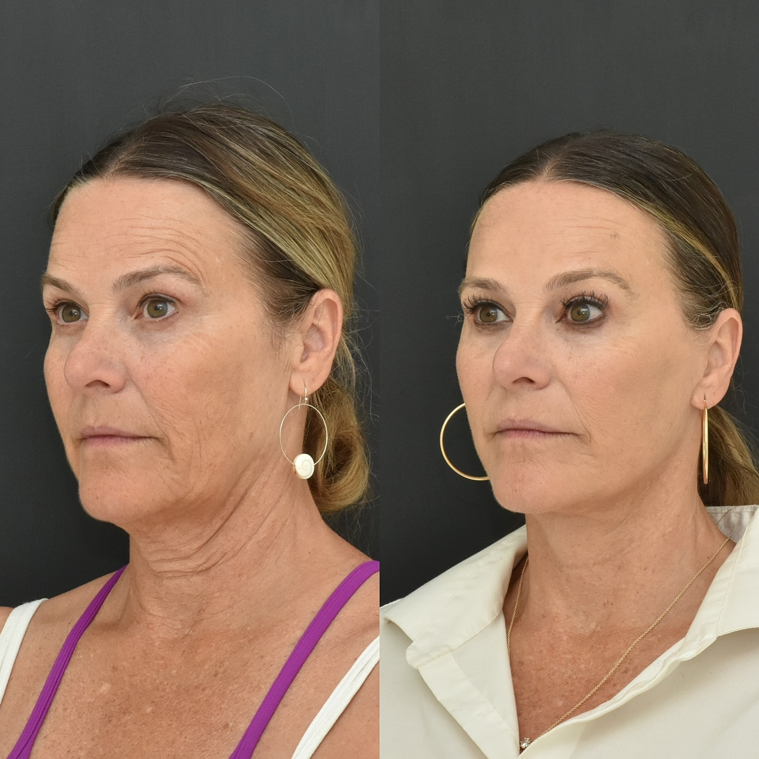 Facelift  Before & After