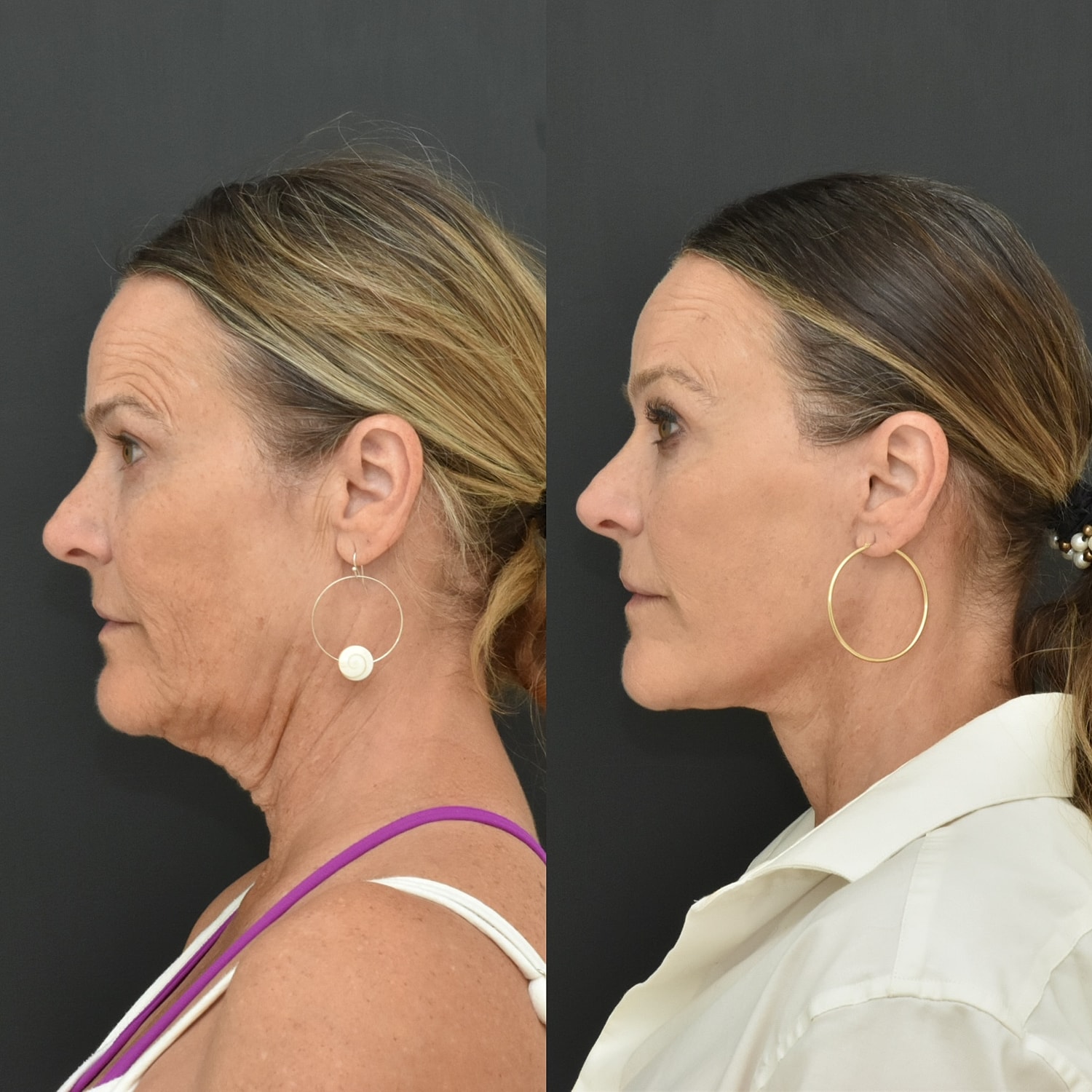 Facelift  Before & After