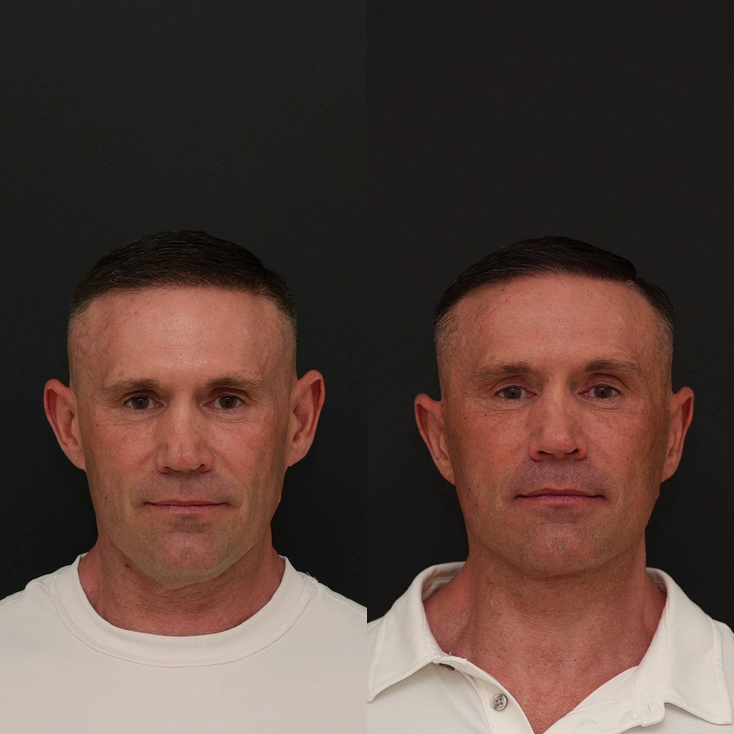 Facelift  Gallery Before & After