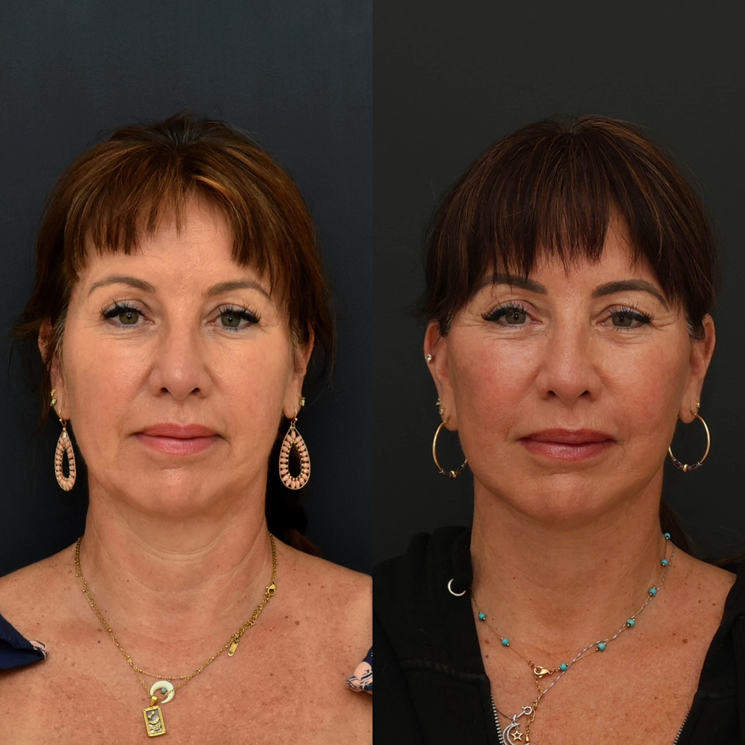 Facelift  Gallery Before & After