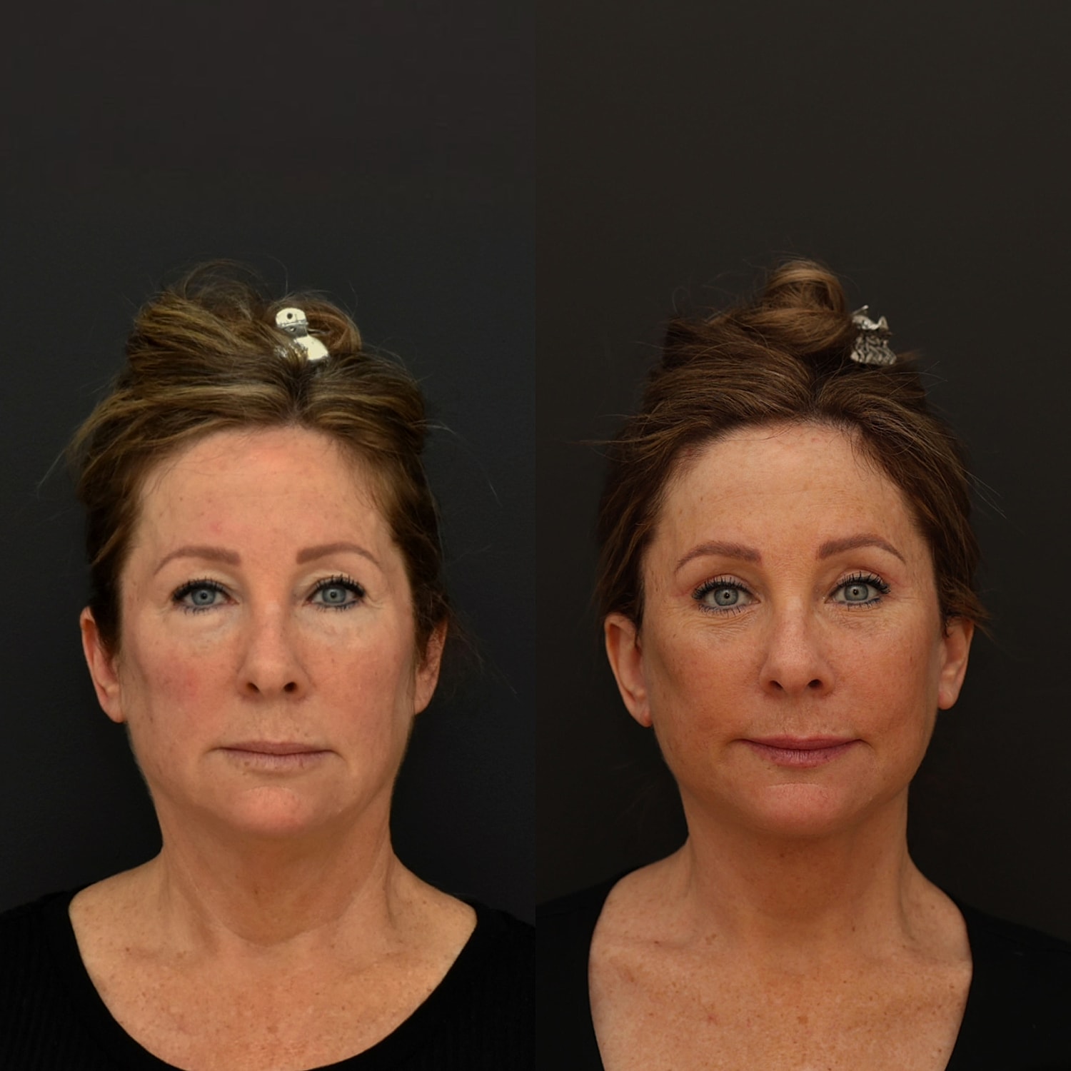 Facelift  Gallery Before & After