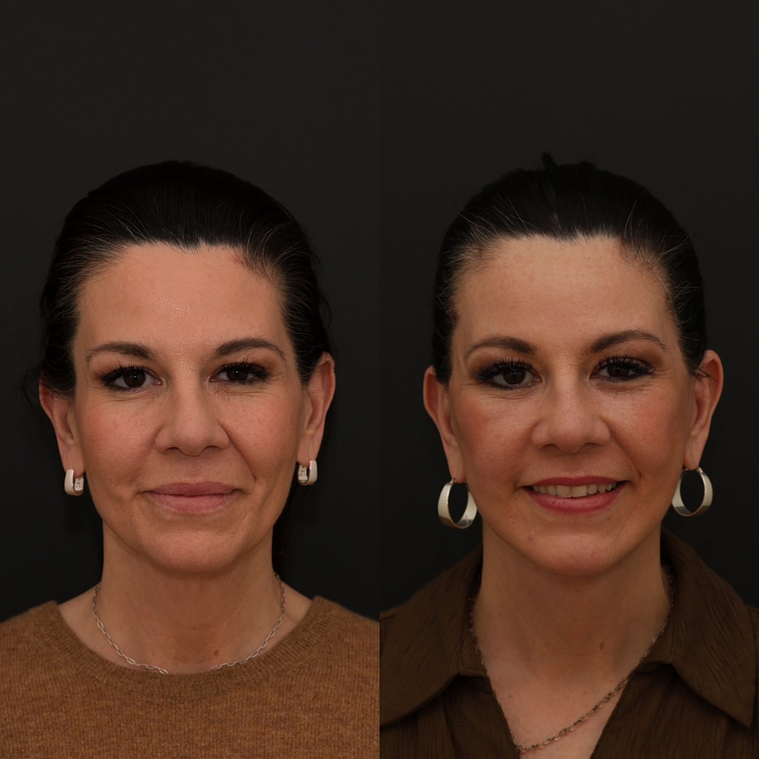 Facelift  Gallery Before & After