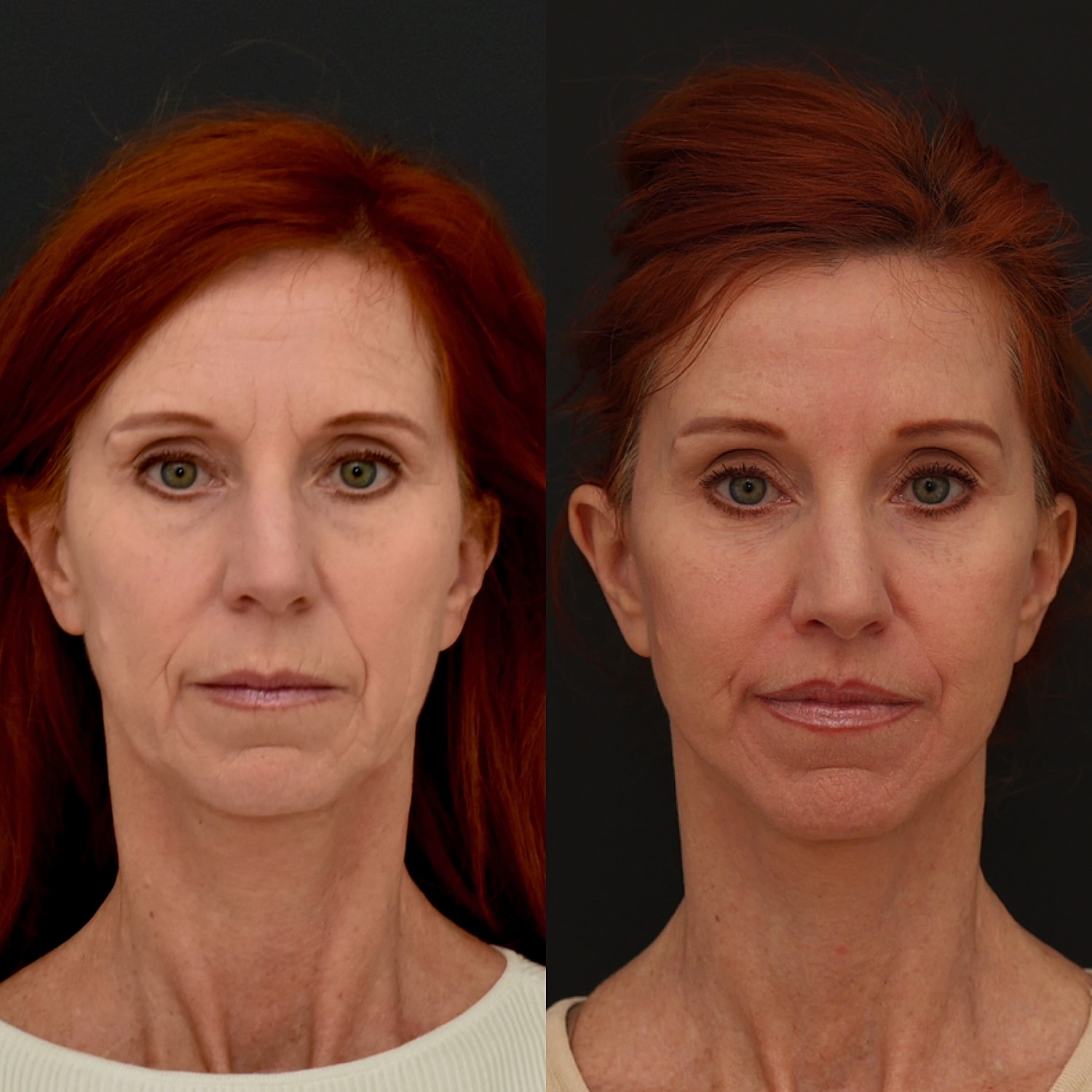 Facelift  Gallery Before & After