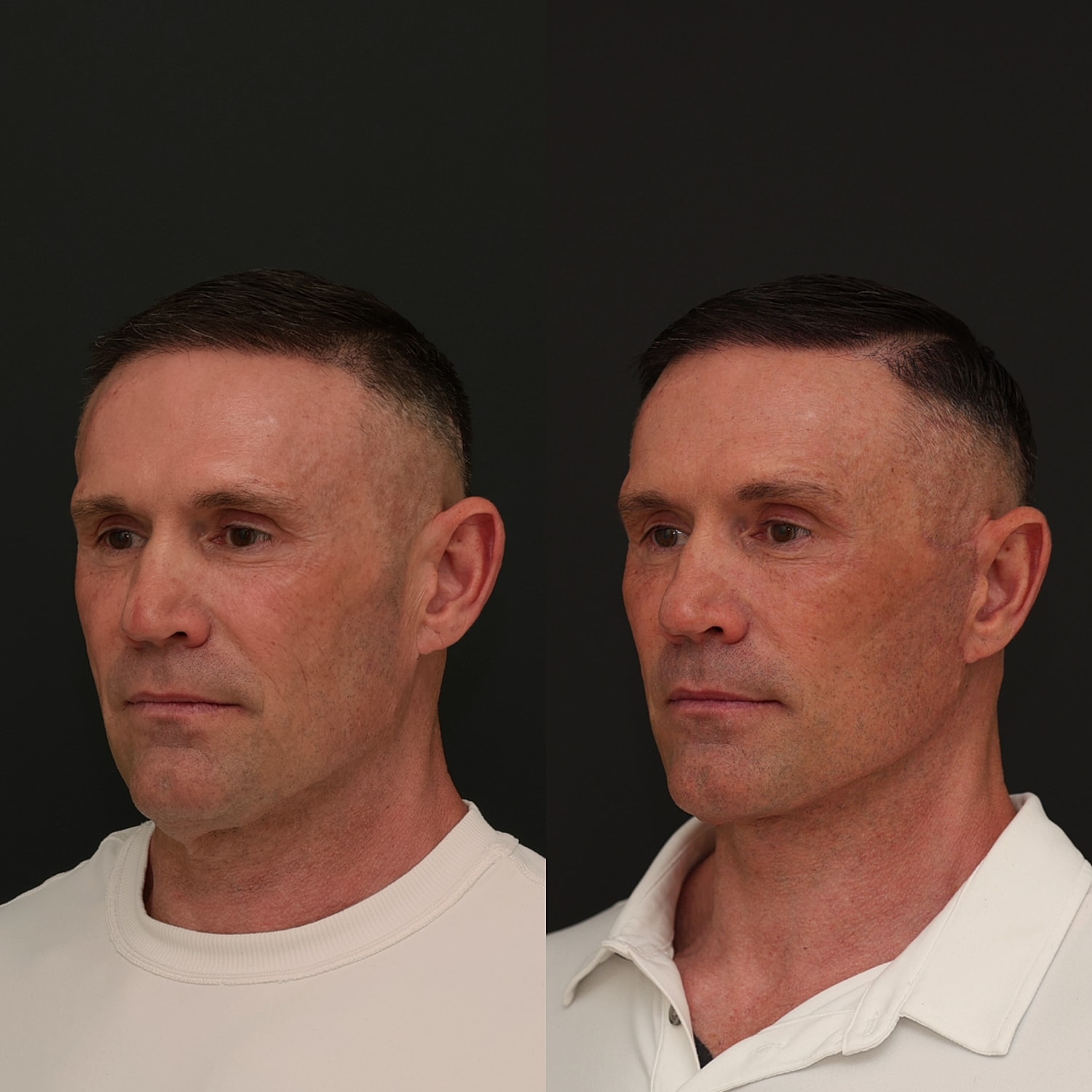 Facelift  Gallery Before & After