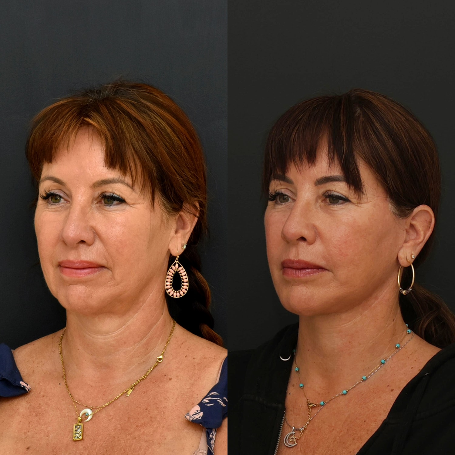 Facelift  Gallery Before & After