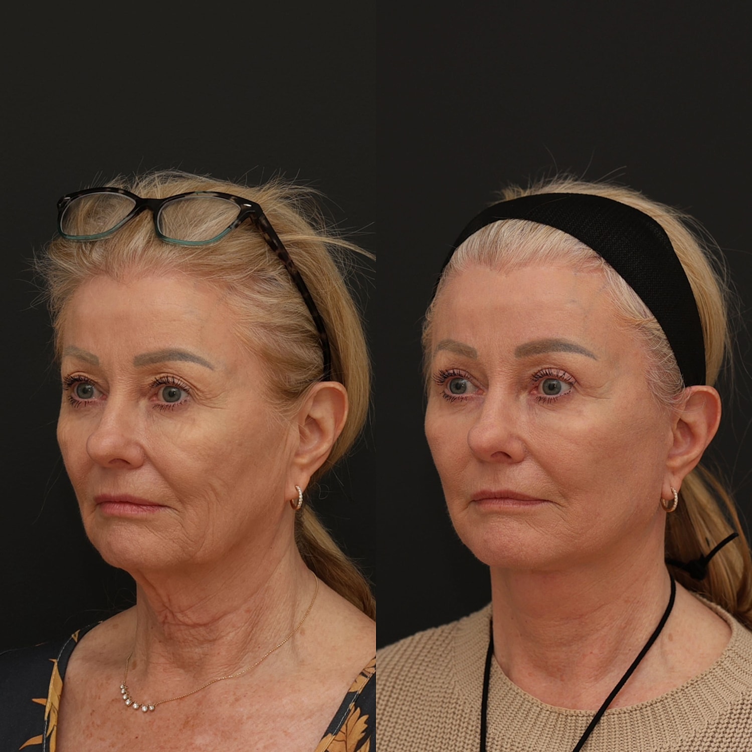 Facelift  Gallery Before & After