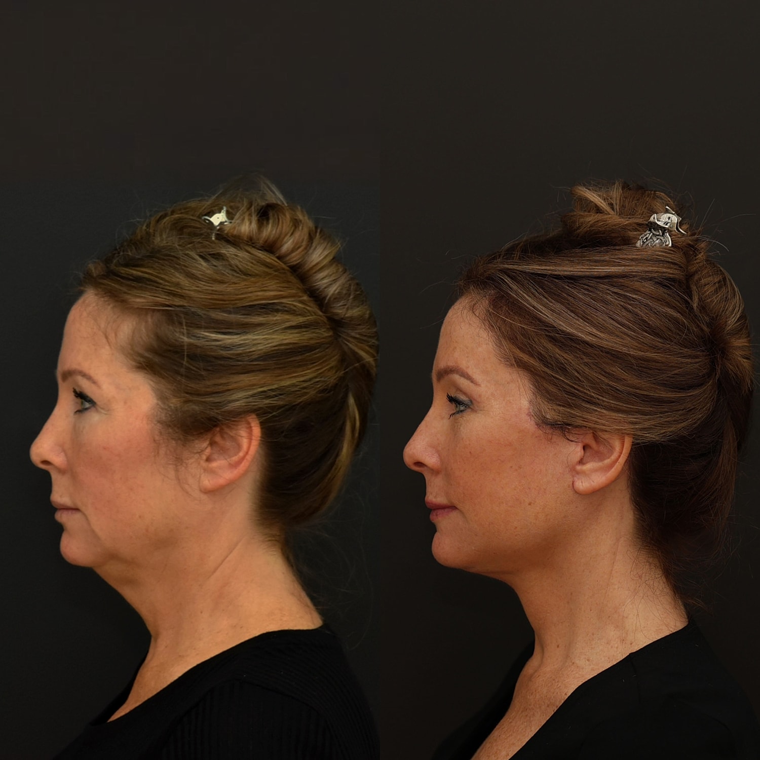 Facelift  Gallery Before & After