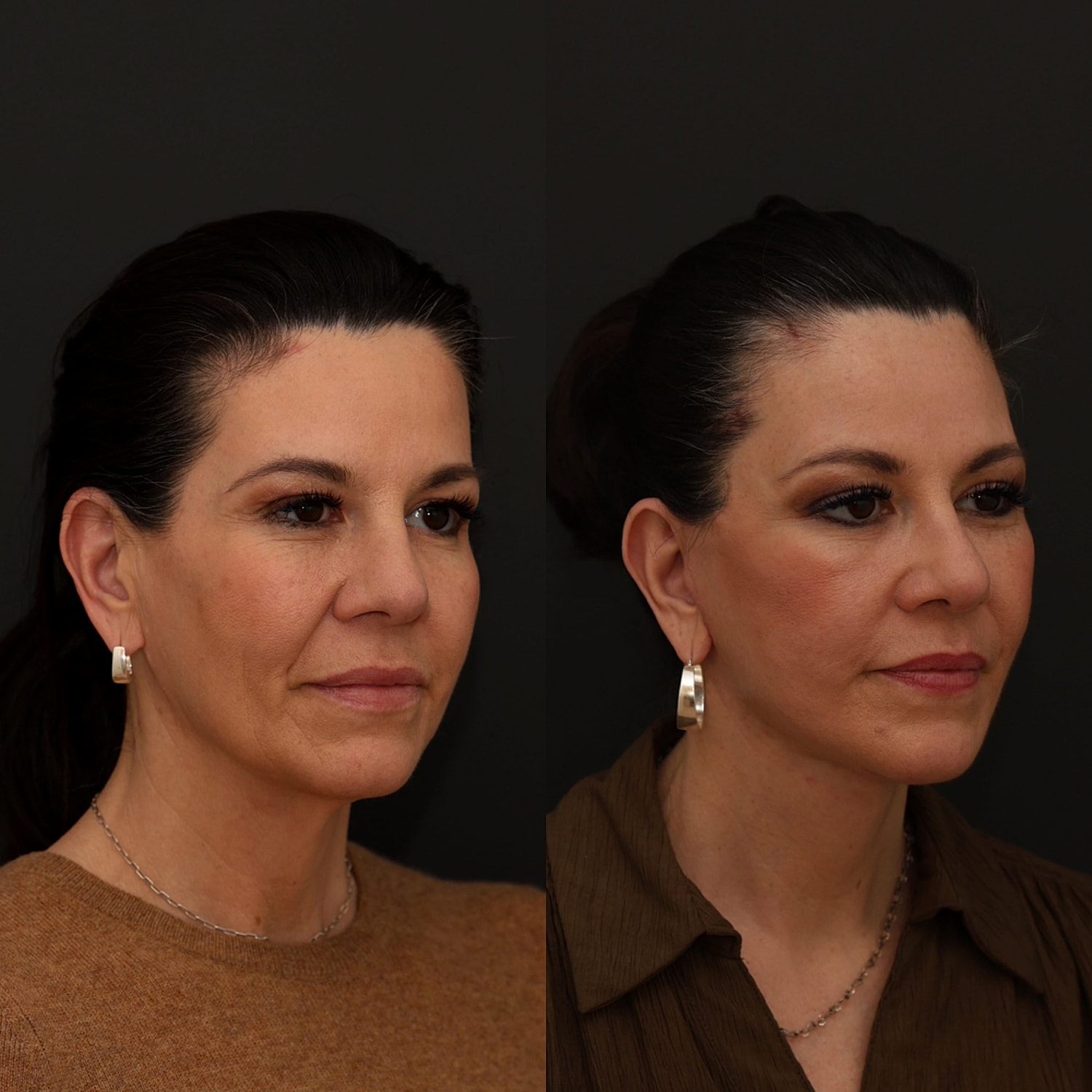 Facelift  Gallery Before & After