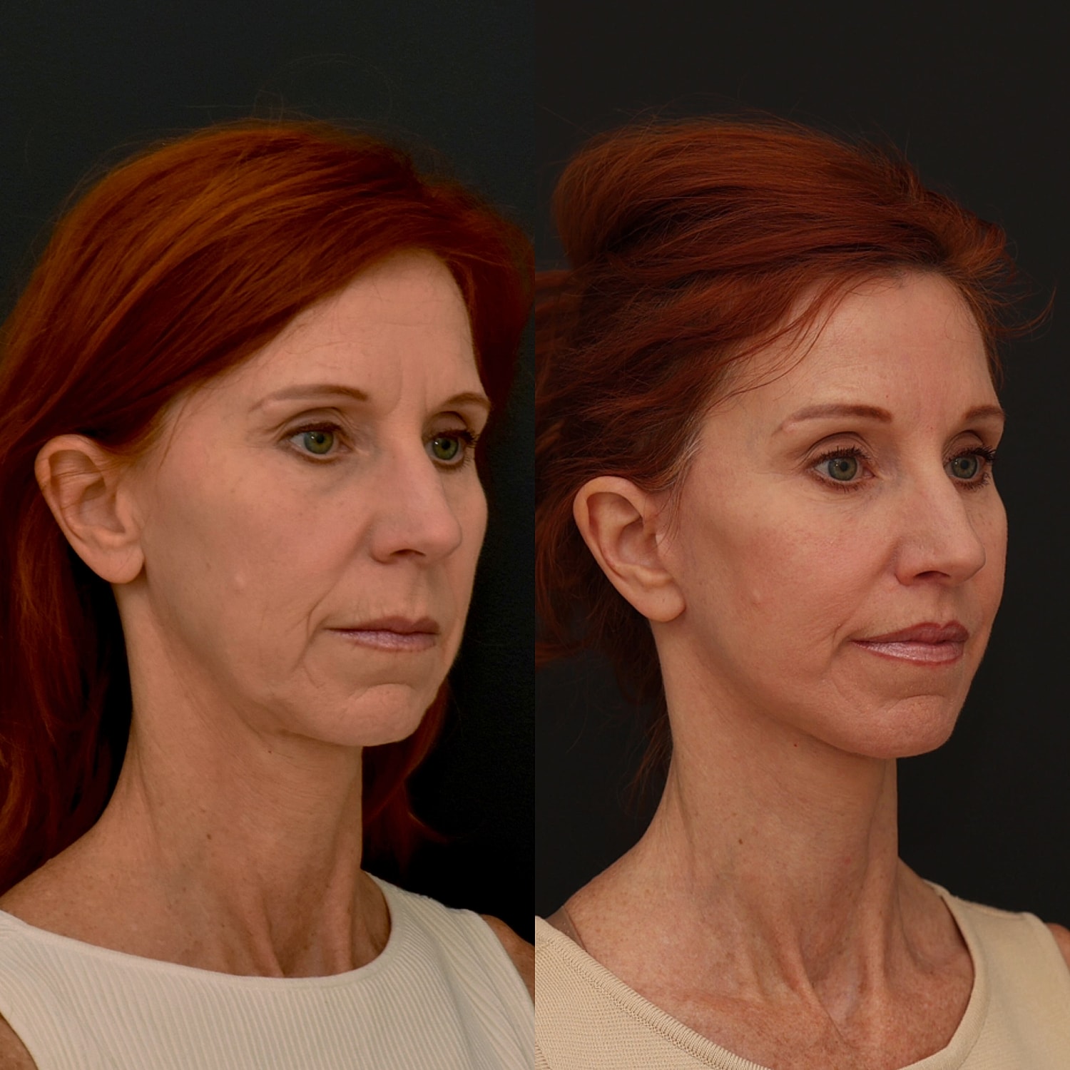 Facelift  Gallery Before & After
