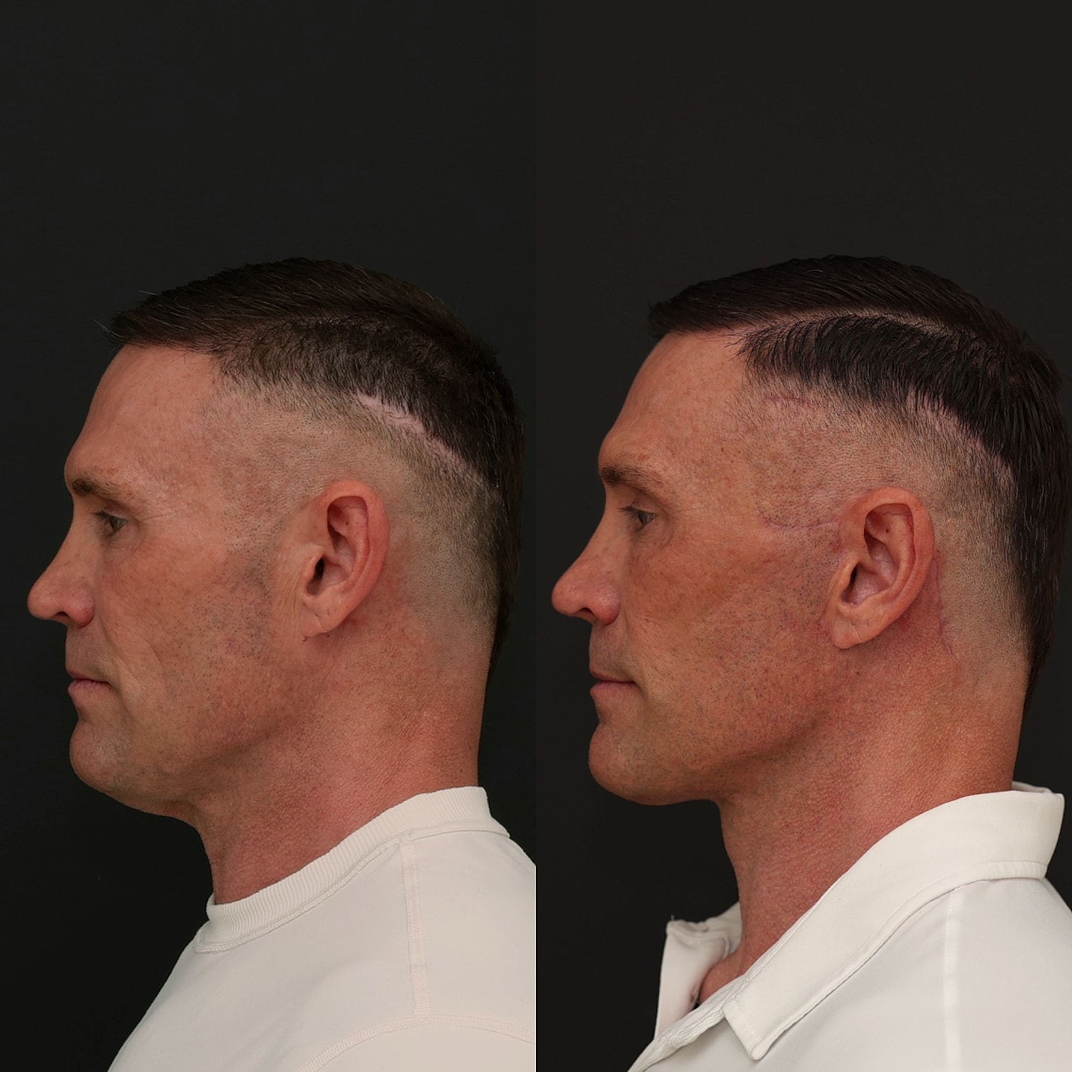 Facelift  Gallery Before & After