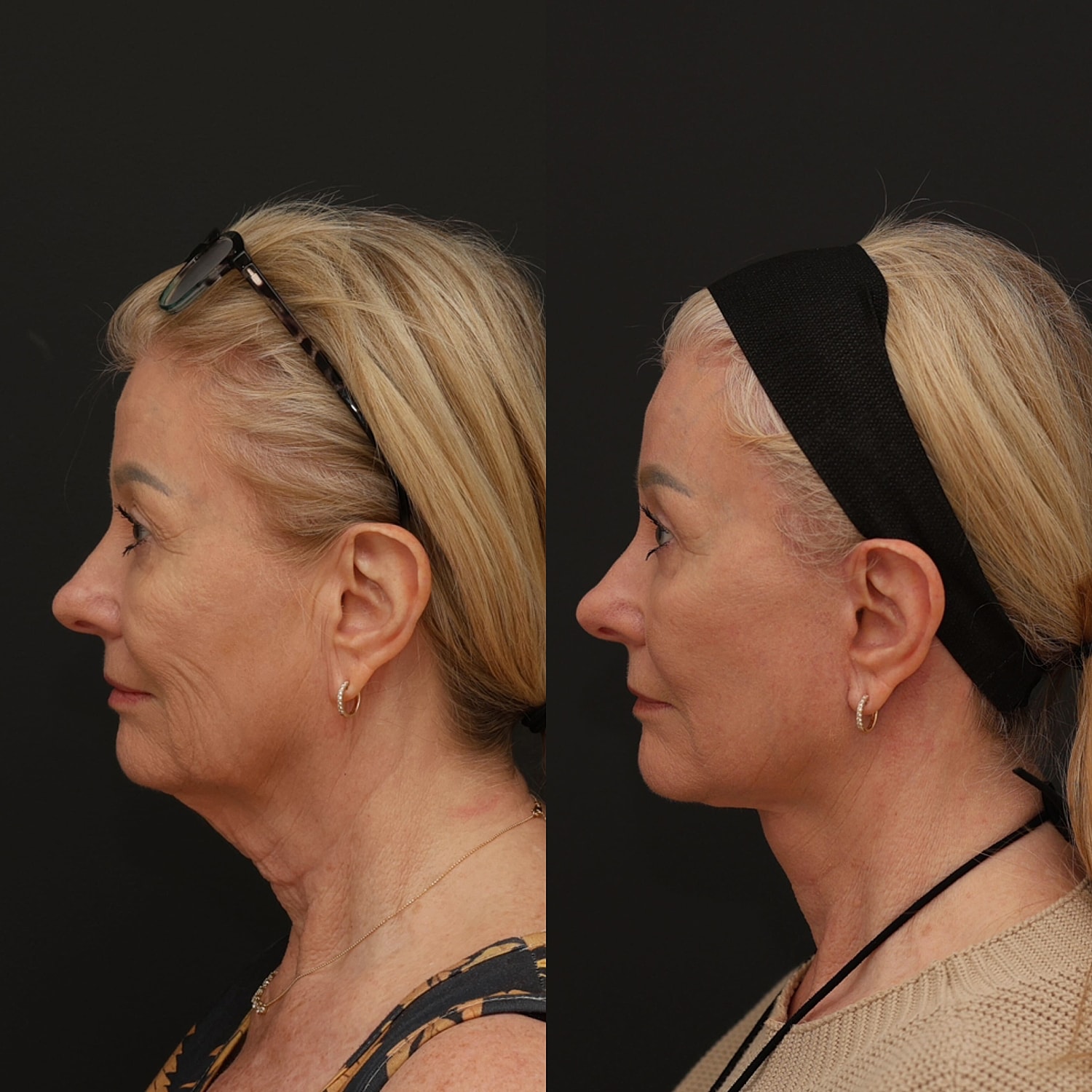 Facelift  Gallery Before & After