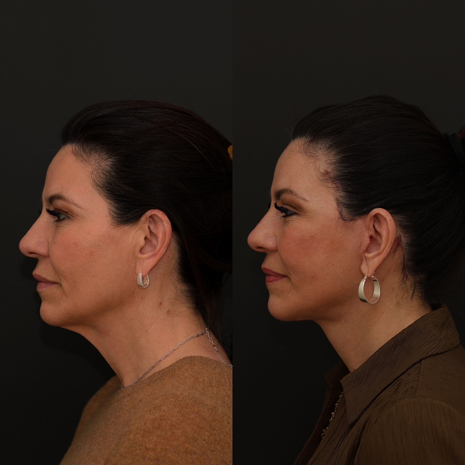 Facelift  Gallery Before & After