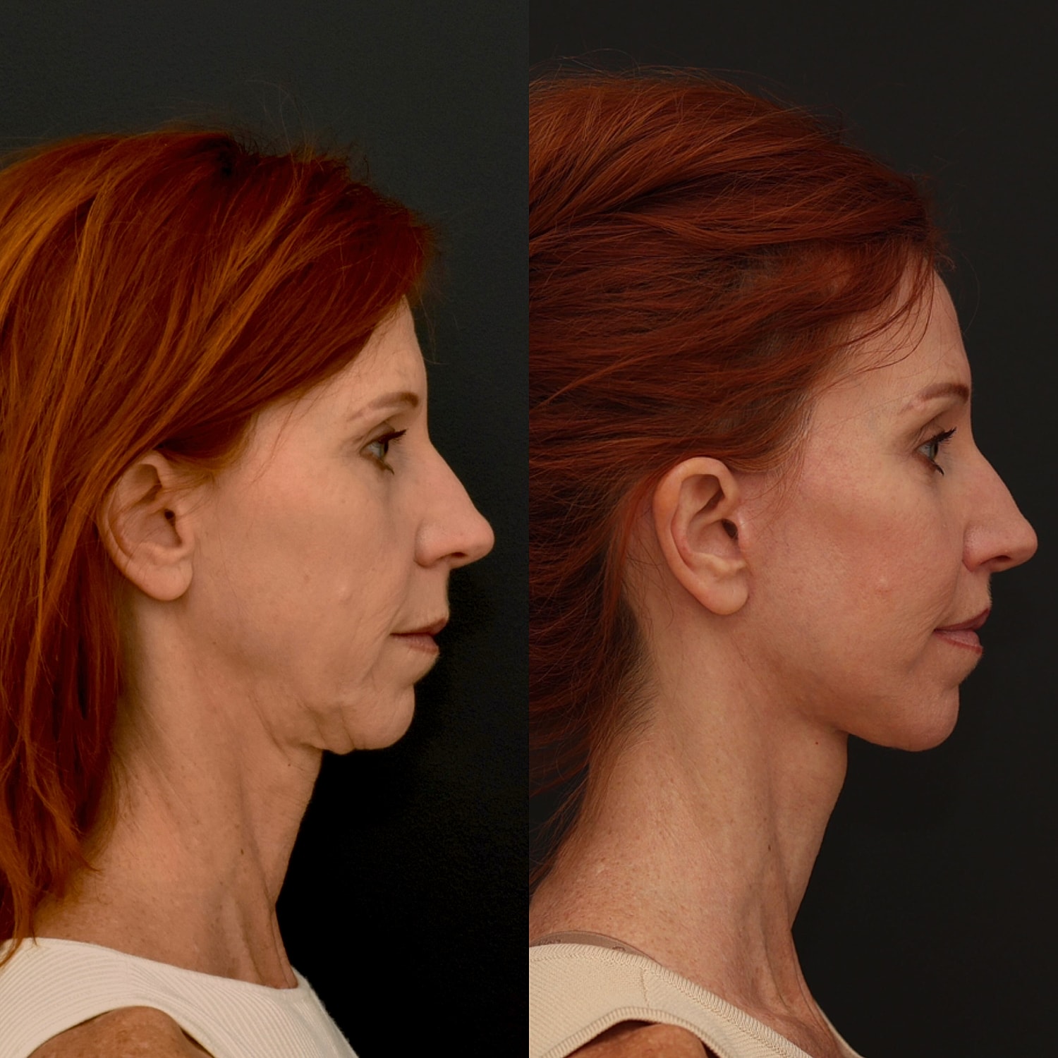 Facelift  Gallery Before & After