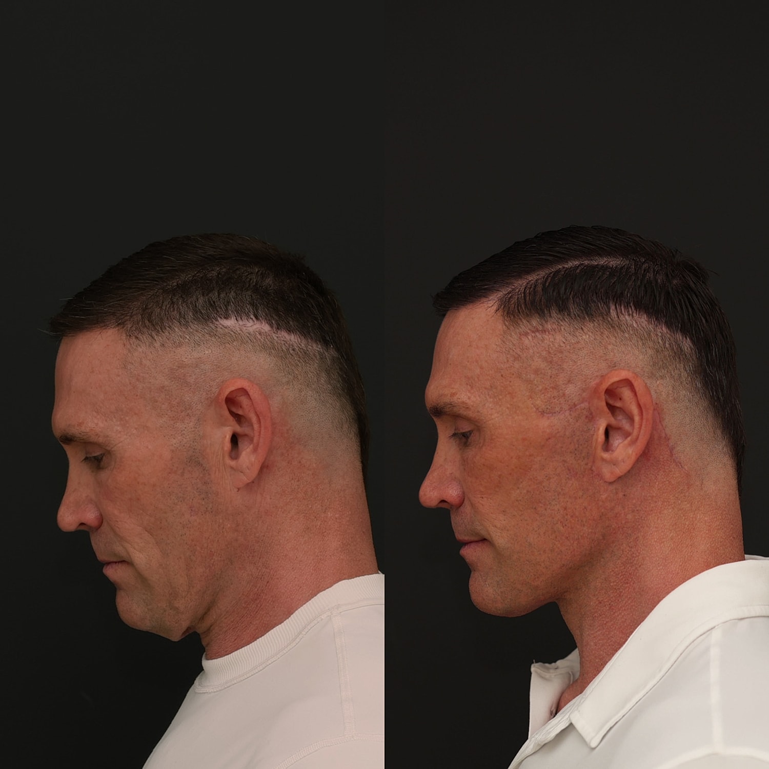 Facelift  Gallery Before & After