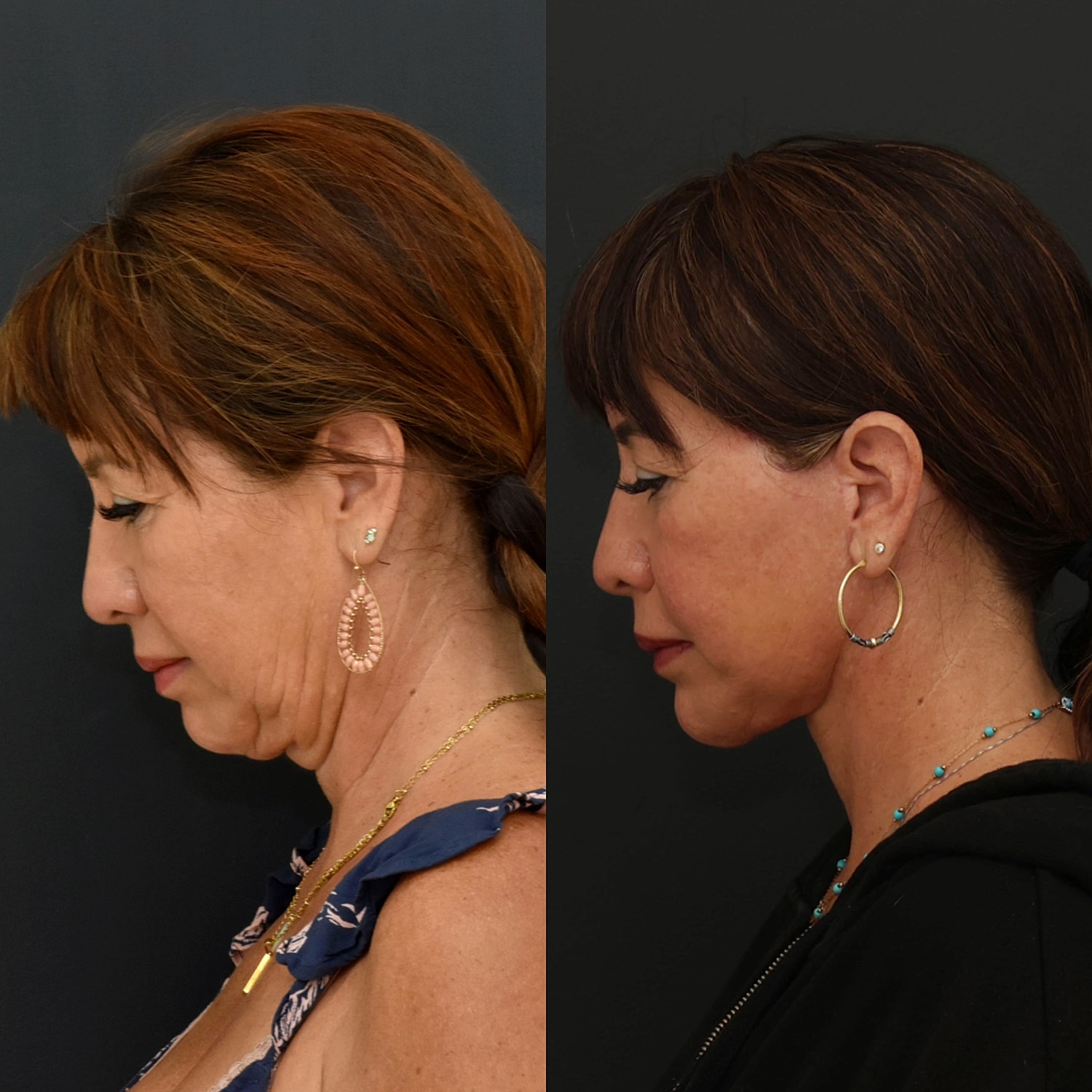 Facelift  Gallery Before & After