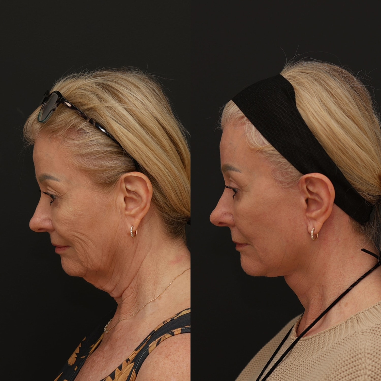 Facelift  Gallery Before & After