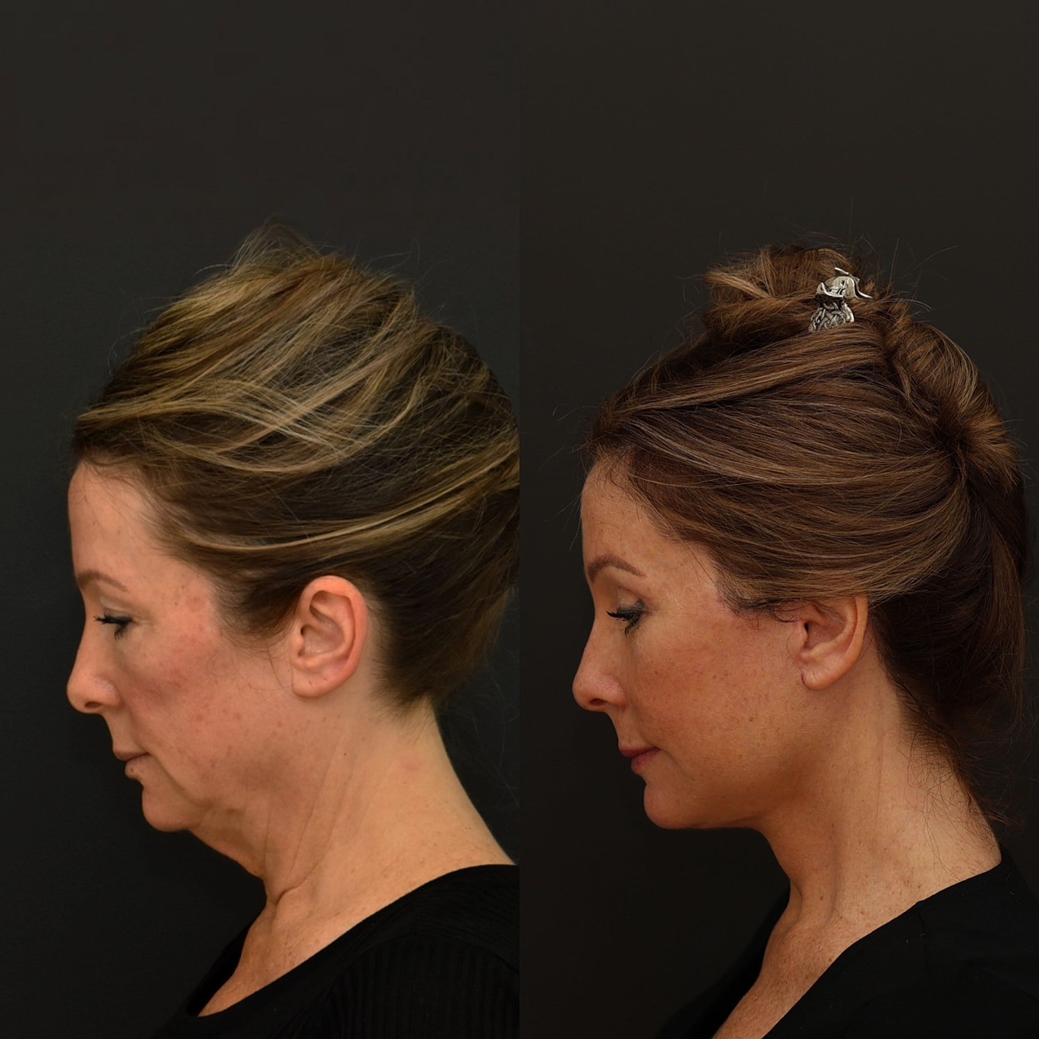 Facelift  Gallery Before & After