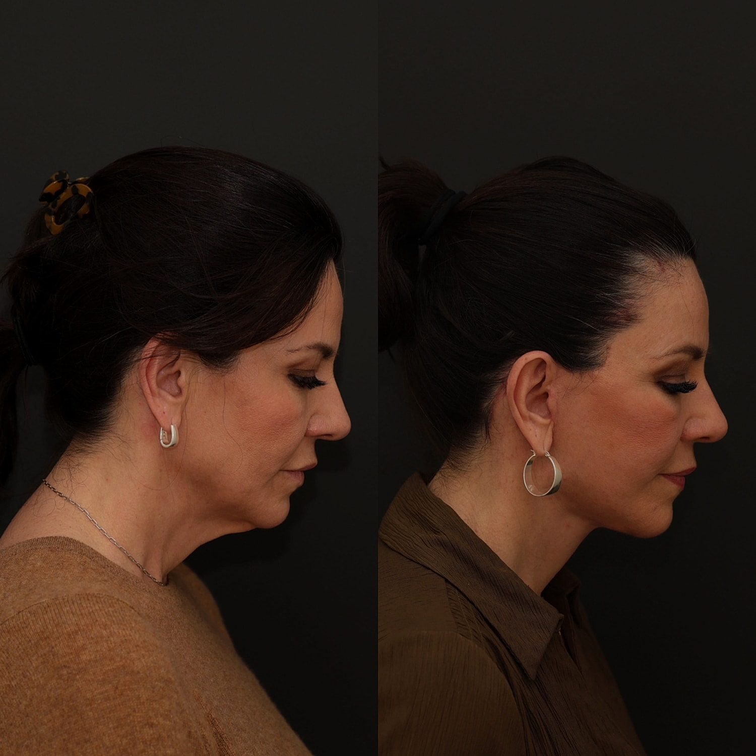 Facelift  Gallery Before & After