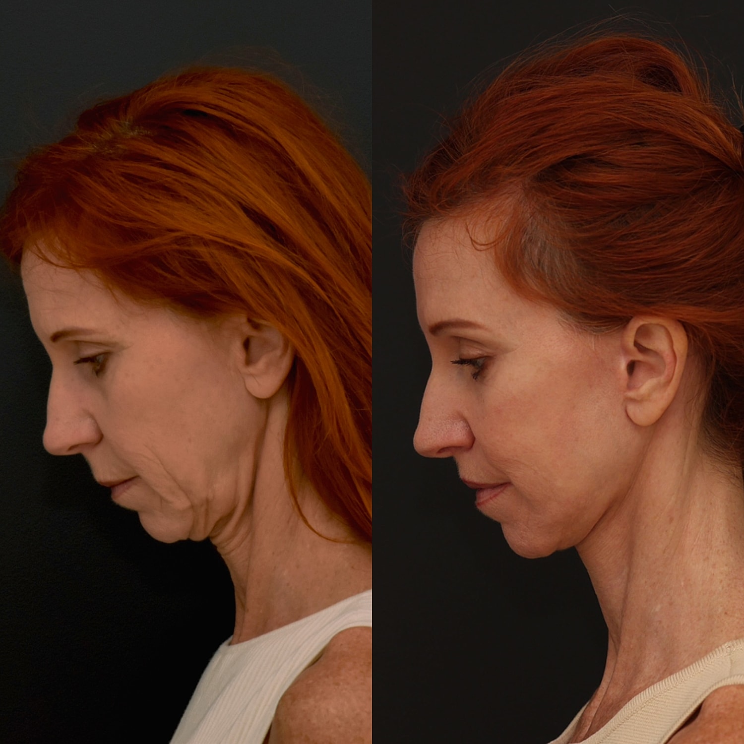 Facelift  Gallery Before & After