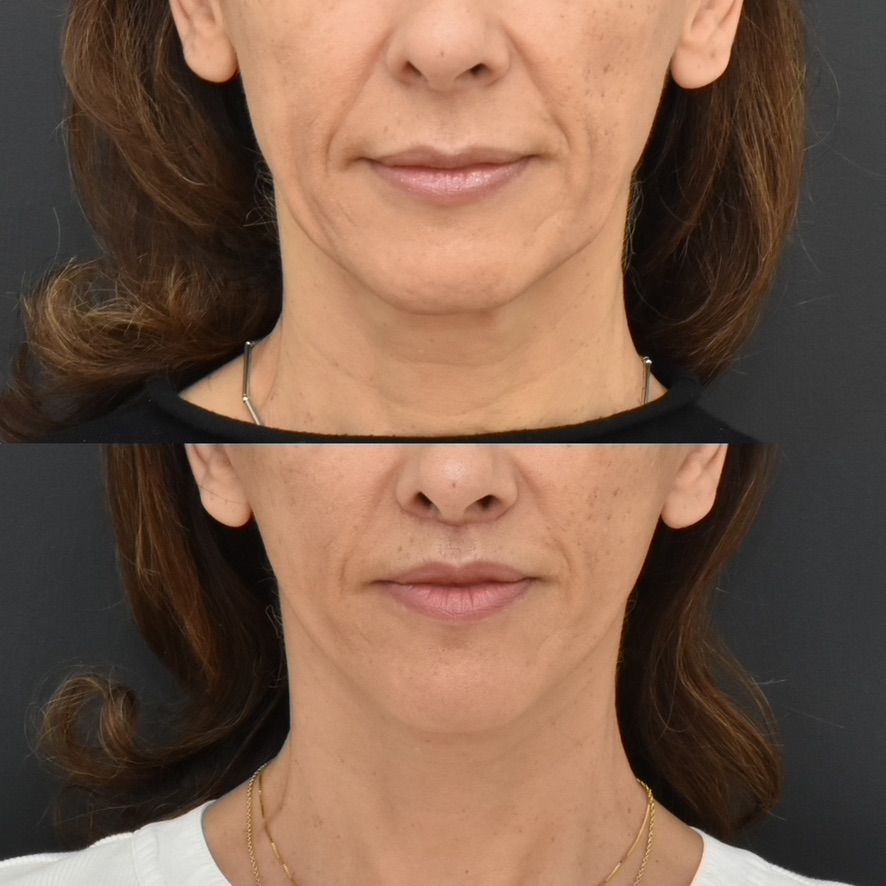 Facelift  Before & After