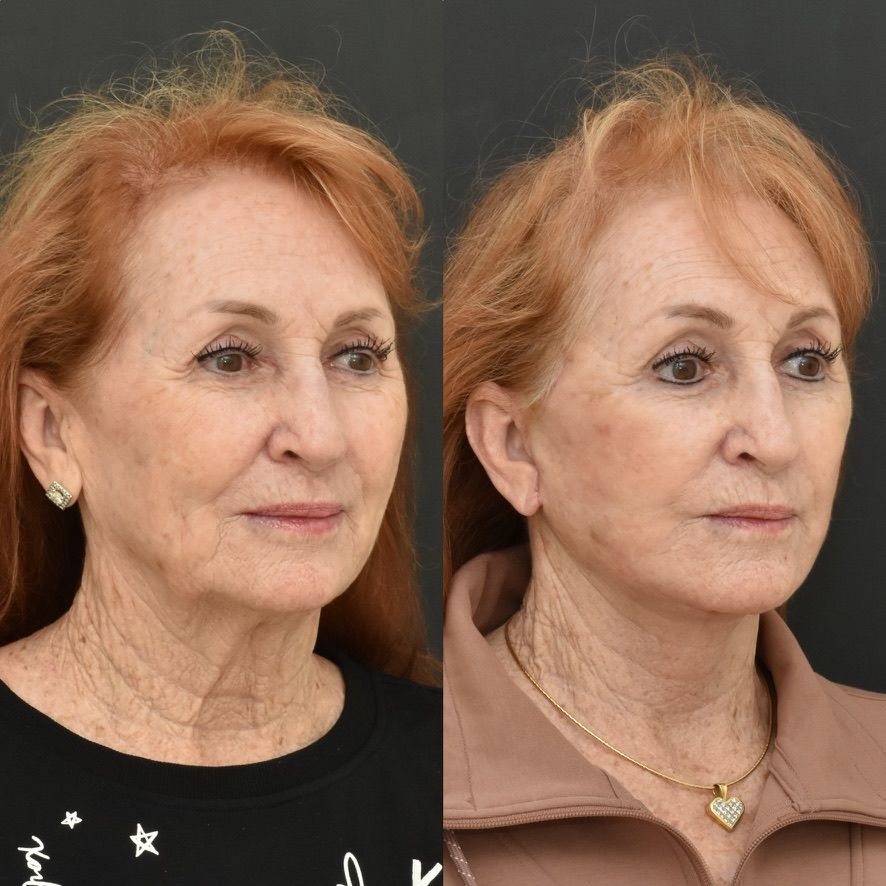 Facelift  Before & After