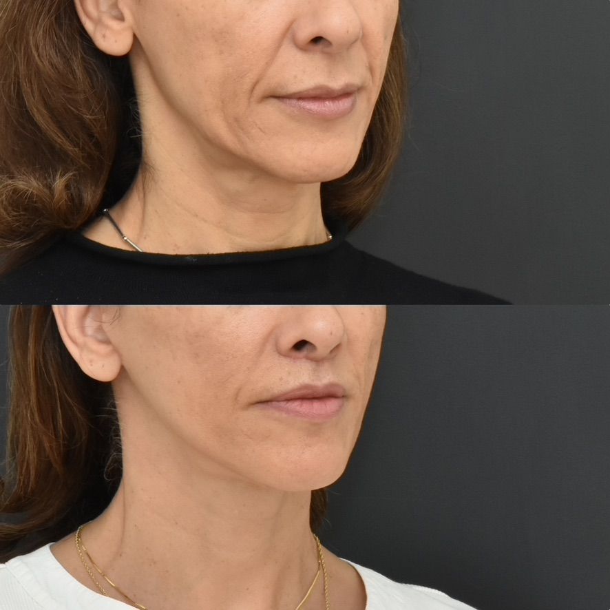 Facelift  Before & After