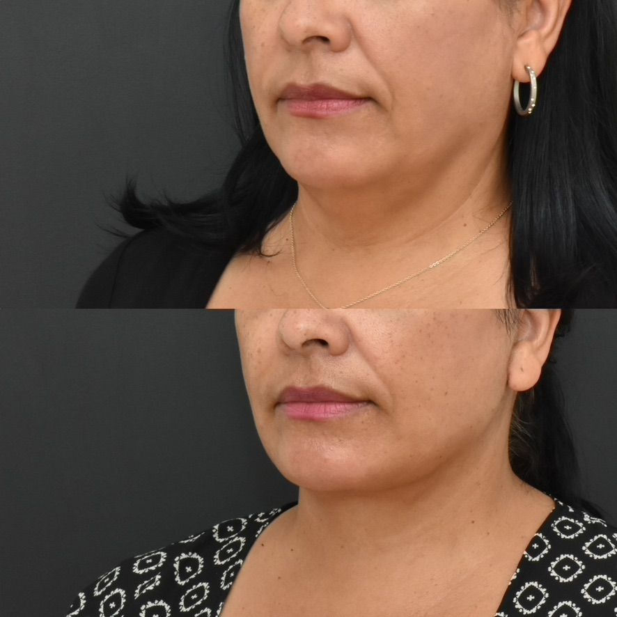 Facelift  Before & After