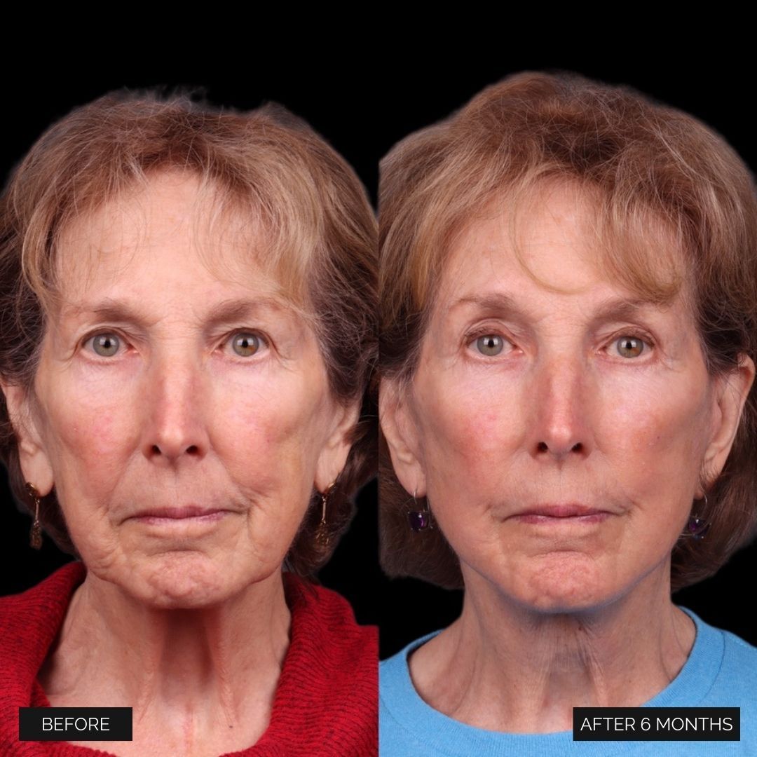 Facelift  Before & After