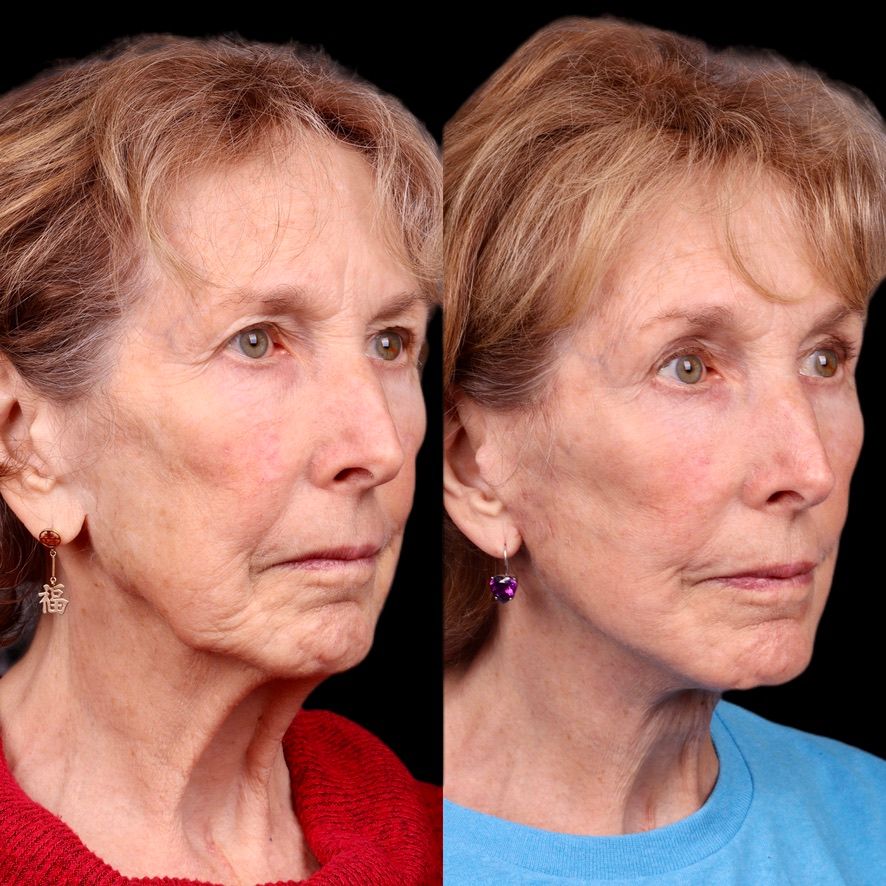 Facelift  Before & After