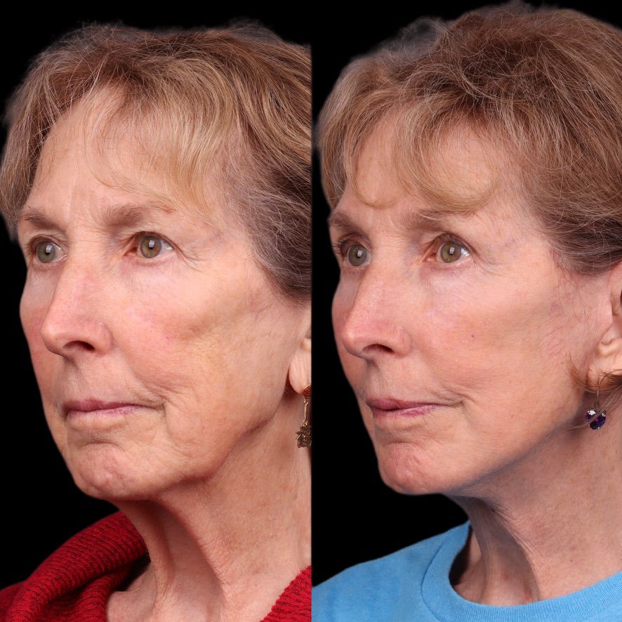 Facelift  Before & After