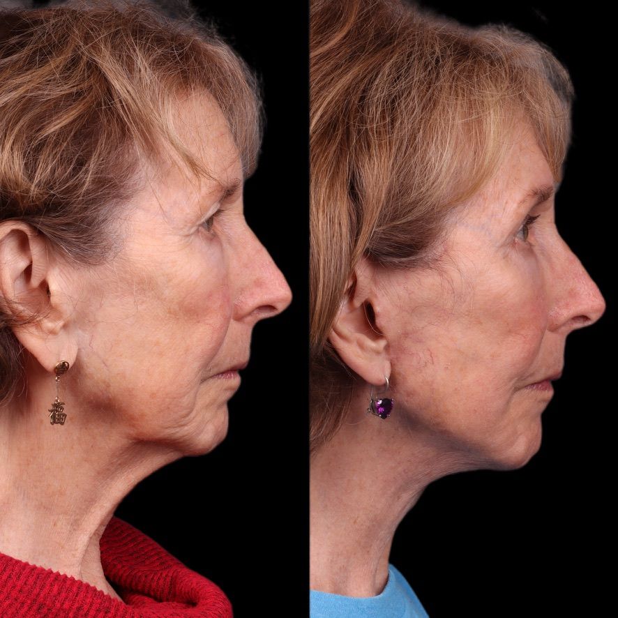 Facelift  Before & After