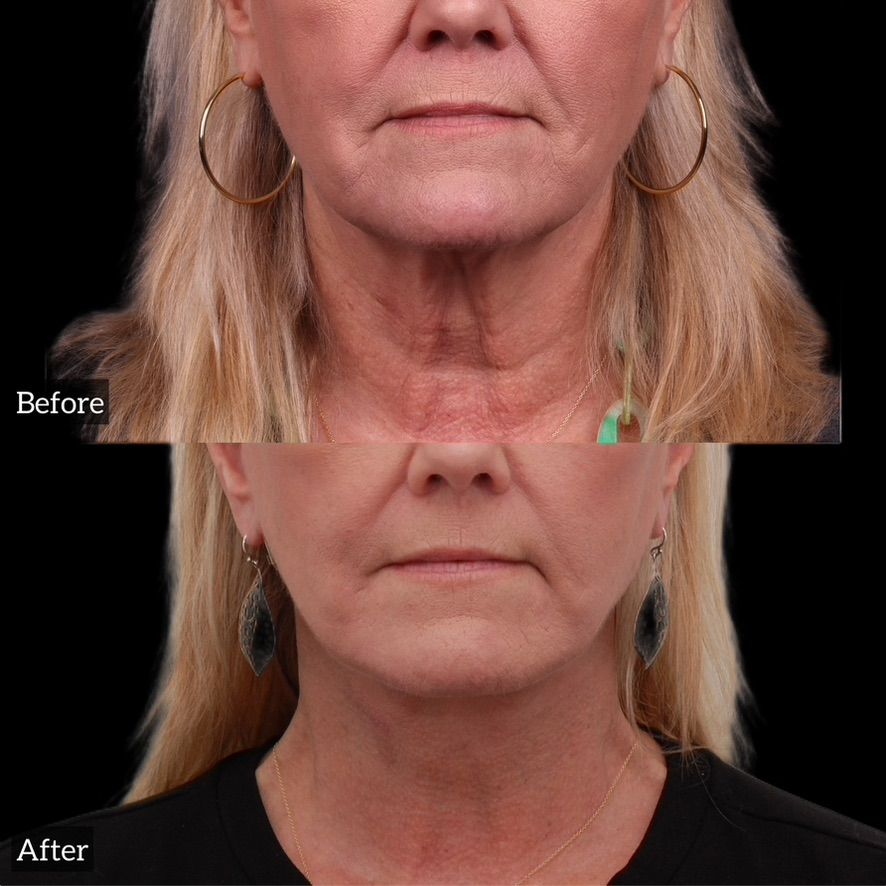 Facelift  Before & After