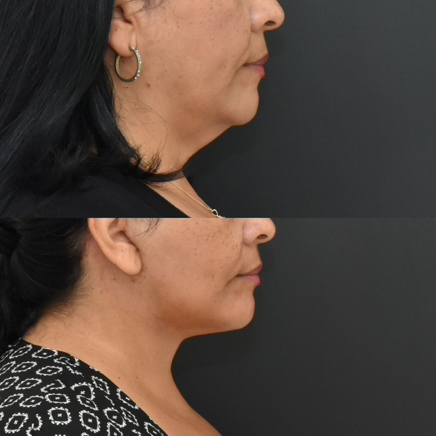 Facelift  Before & After