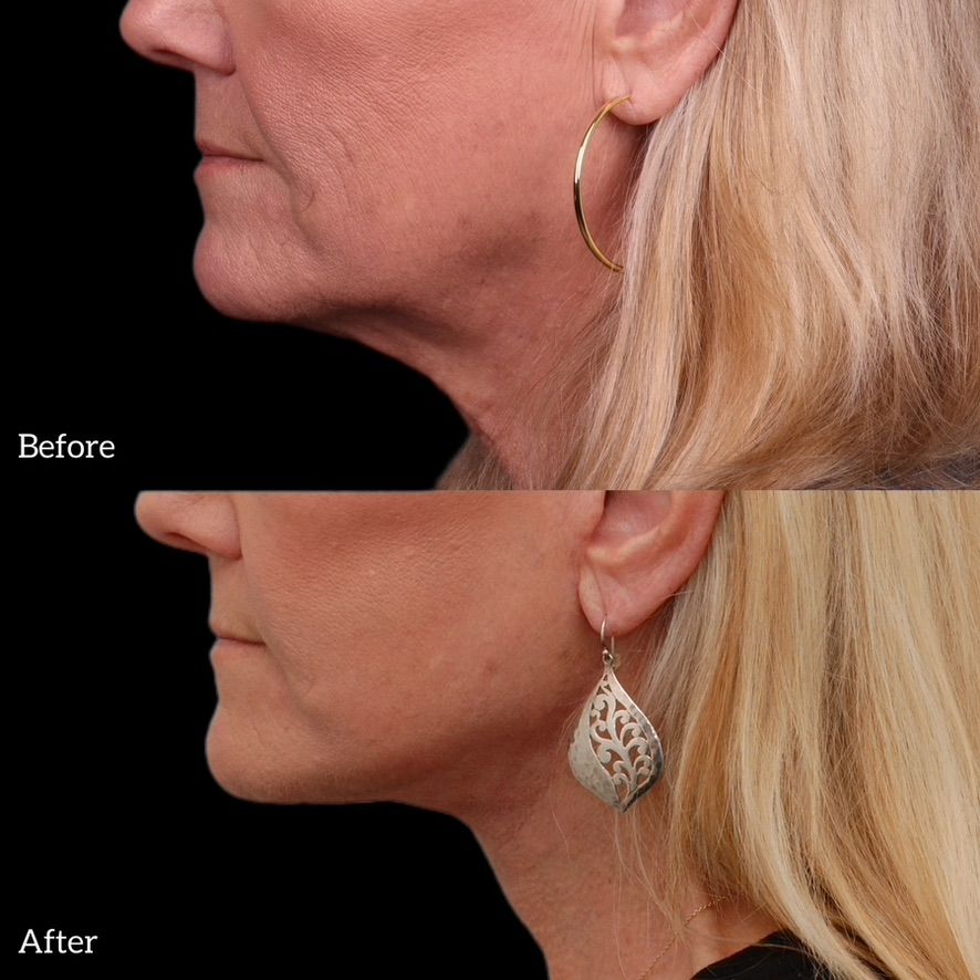 Facelift  Before & After