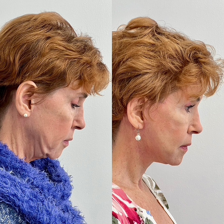 Facelift  Before & After