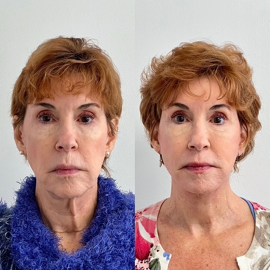 Facelift  Before & After