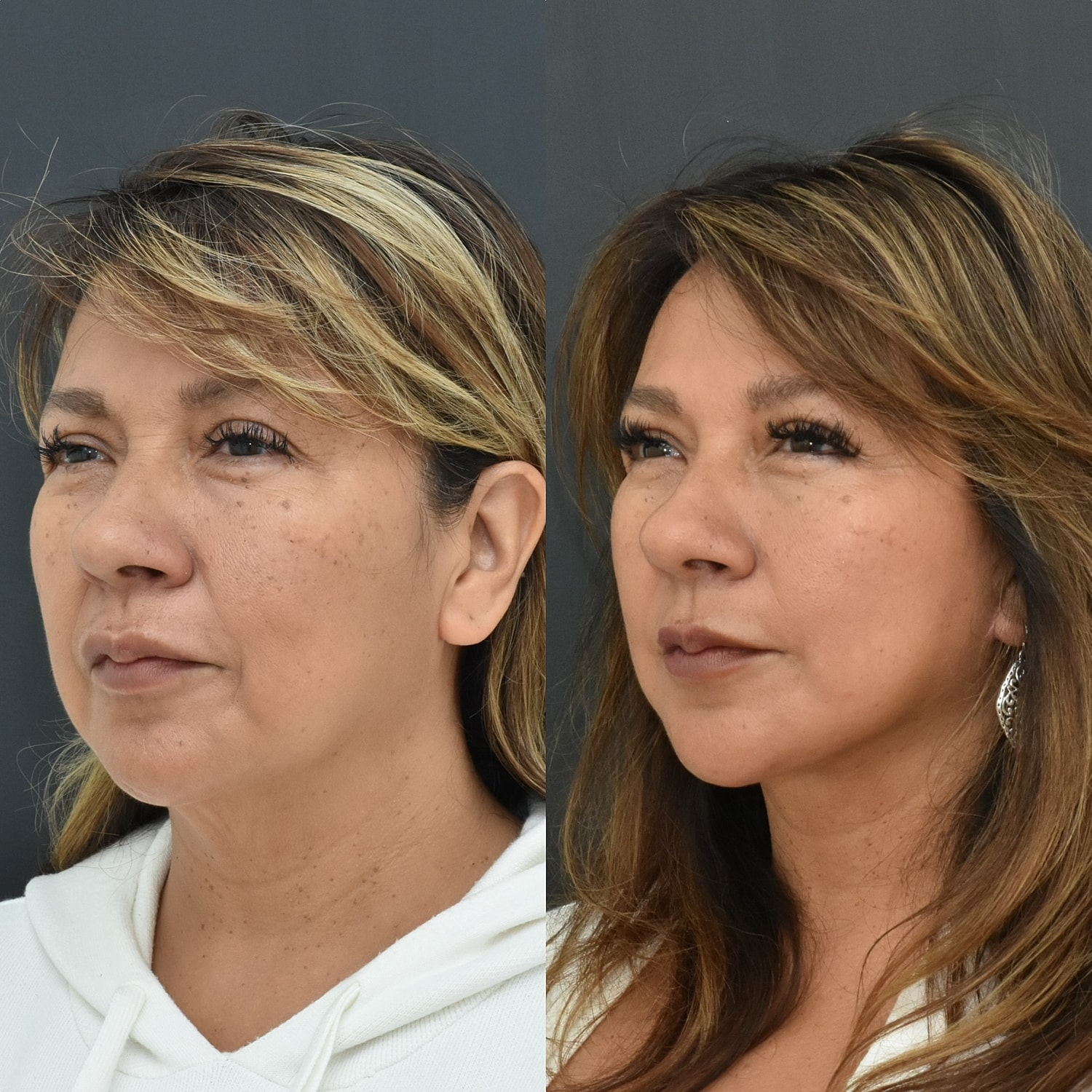 Facelift  Before & After