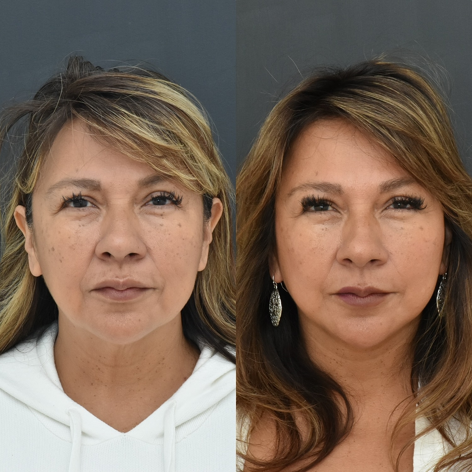 Facelift  Before & After