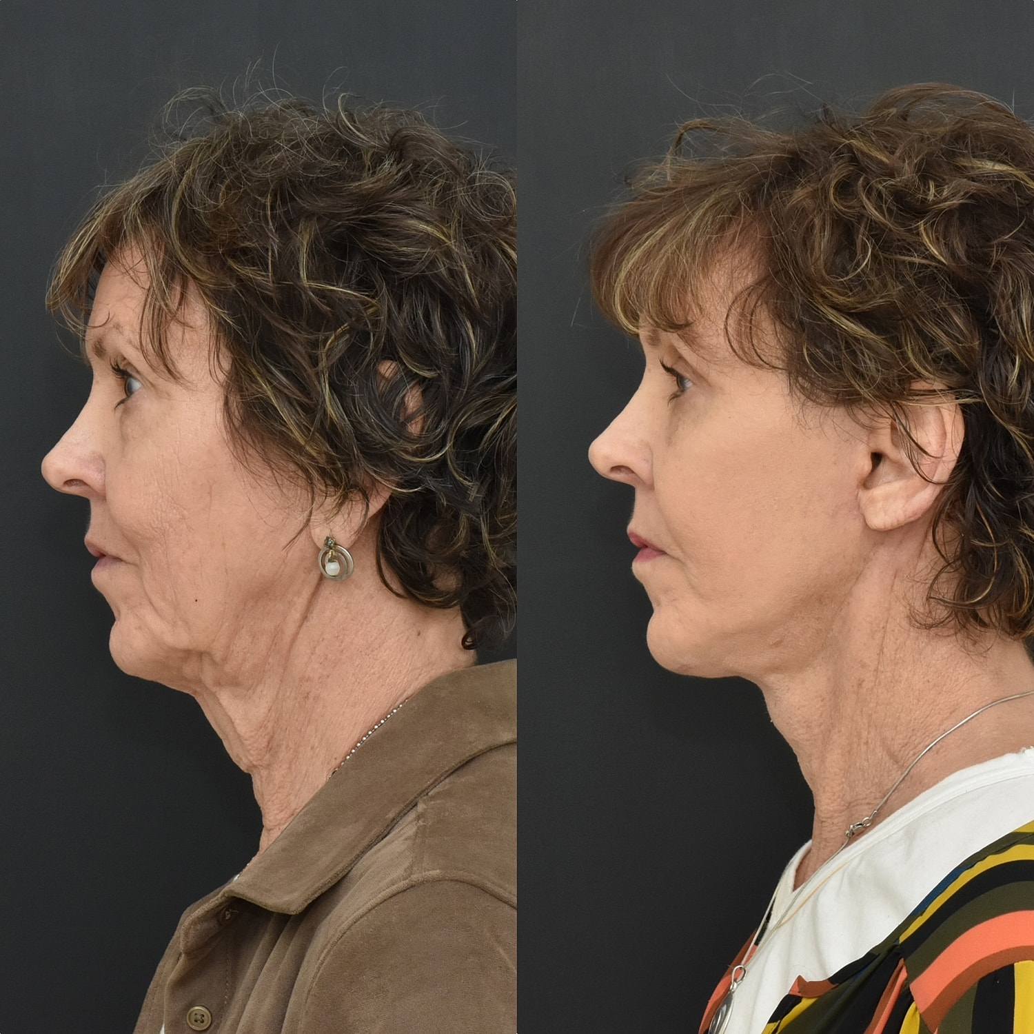 Facelift  Before & After