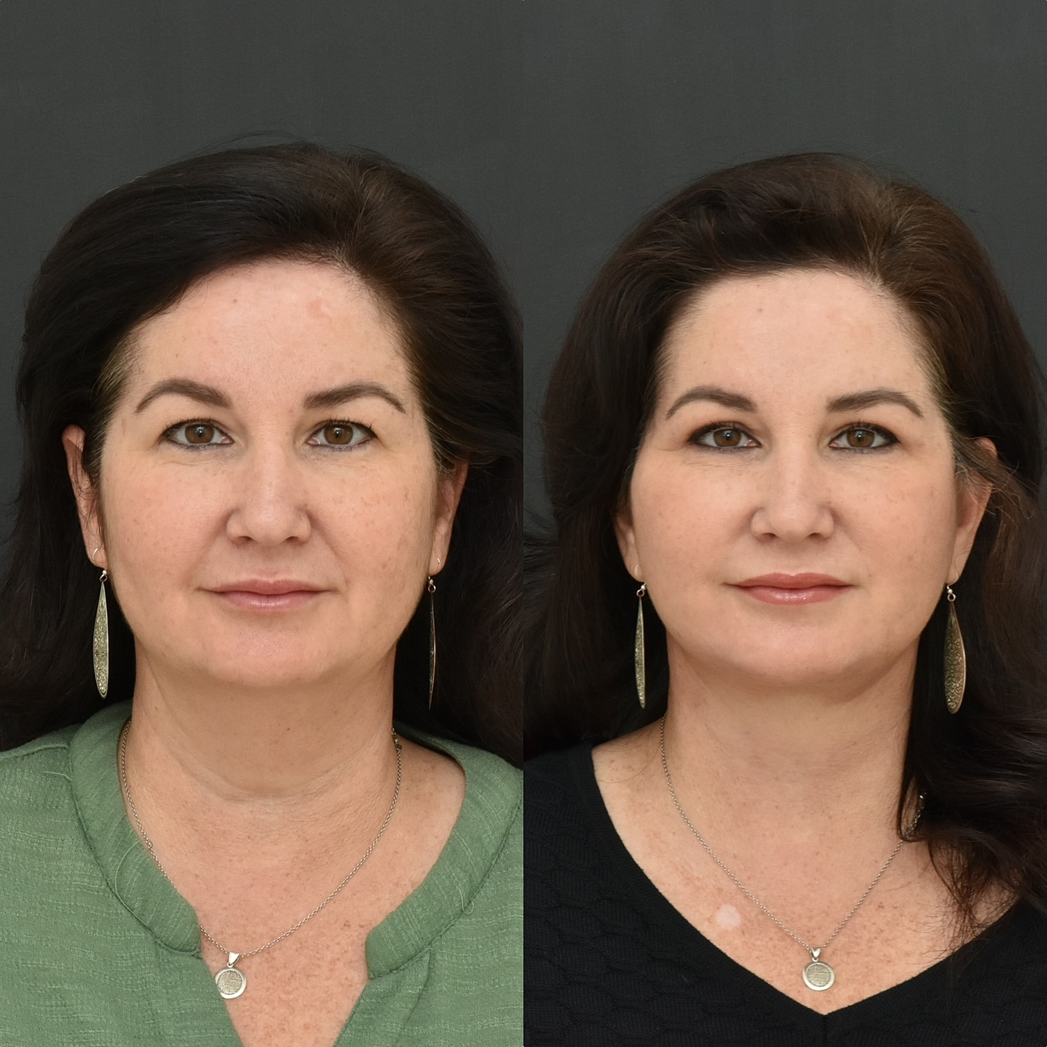 Facelift  Before & After