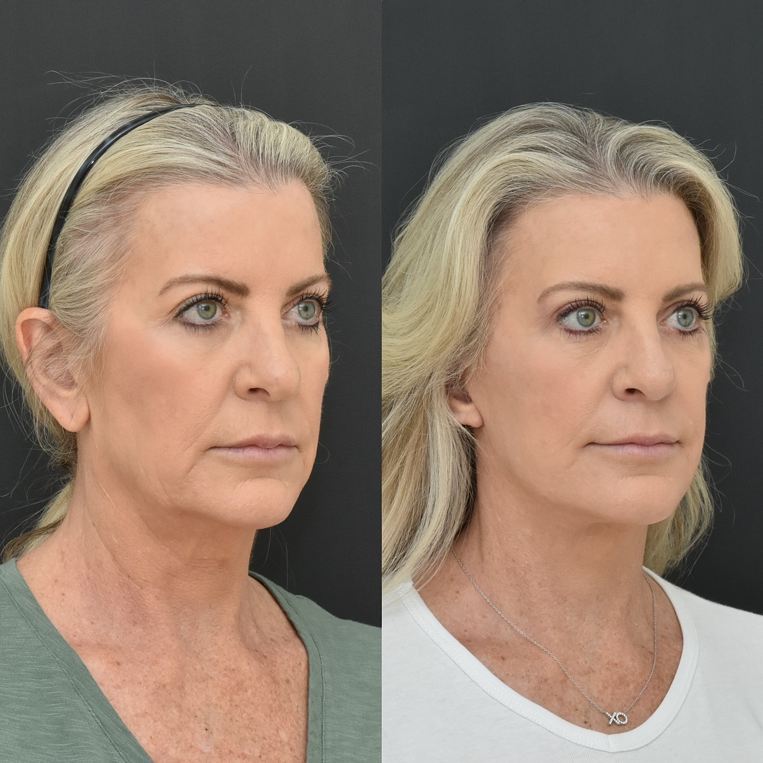 Facelift  Before & After