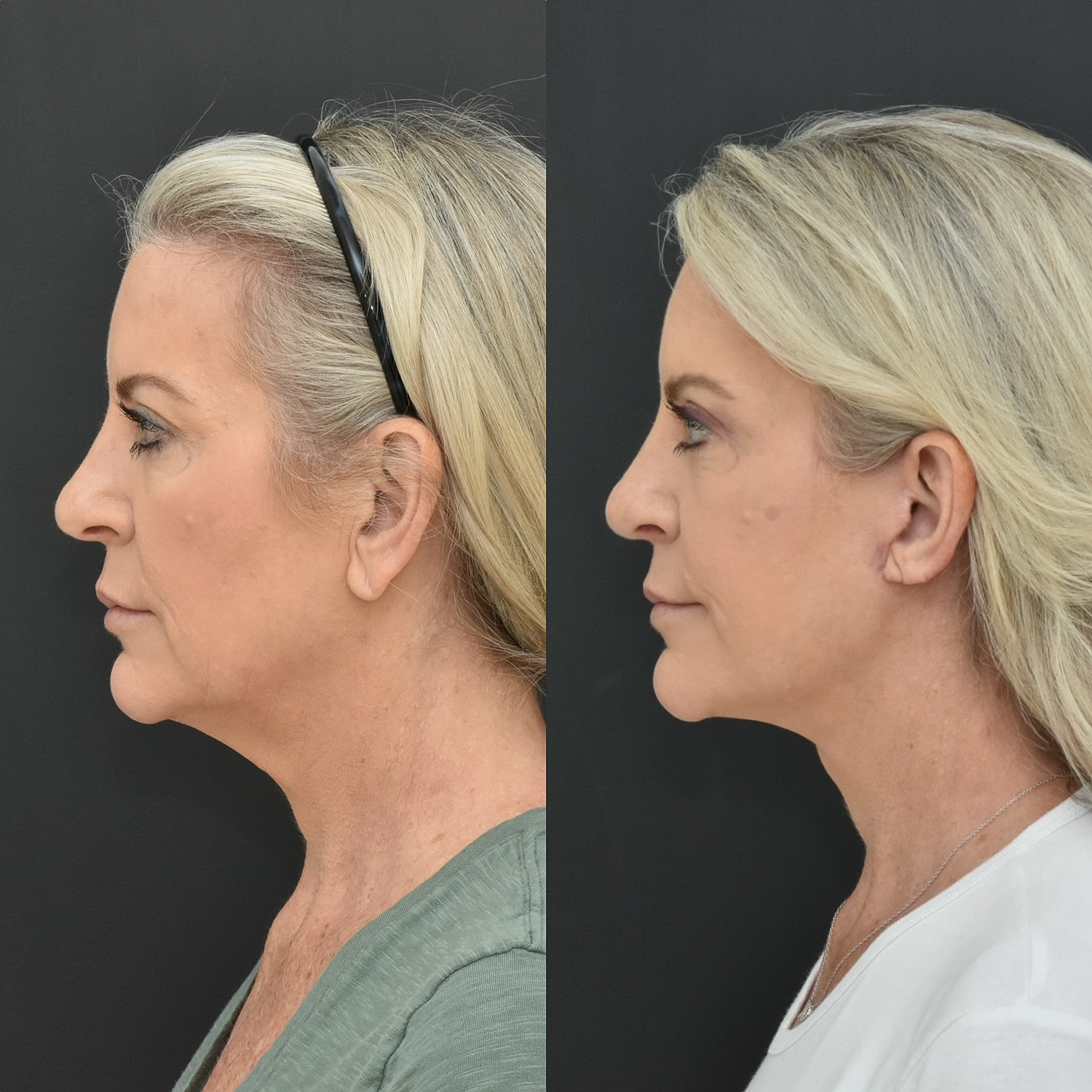 Facelift  Before & After