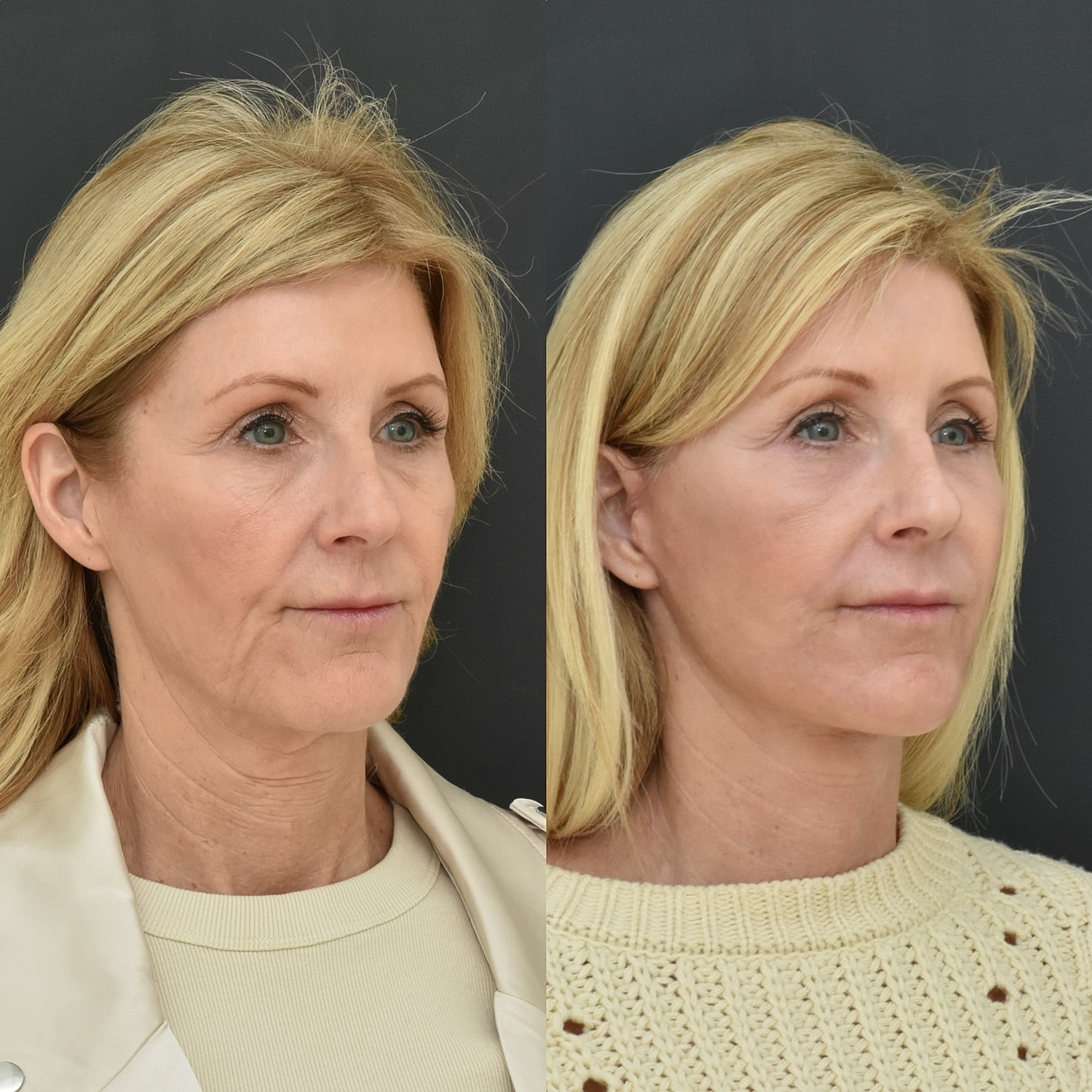 Facelift  Before & After