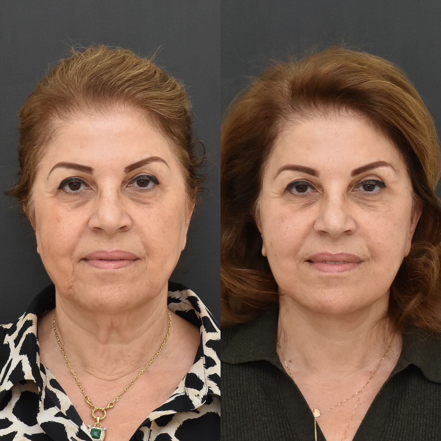 Facelift  Before & After