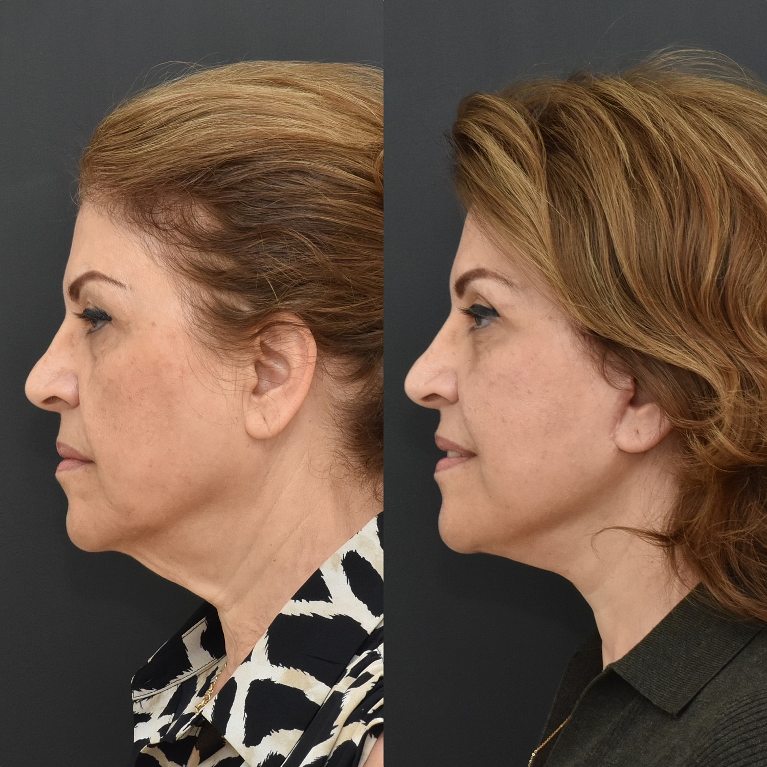Facelift  Before & After