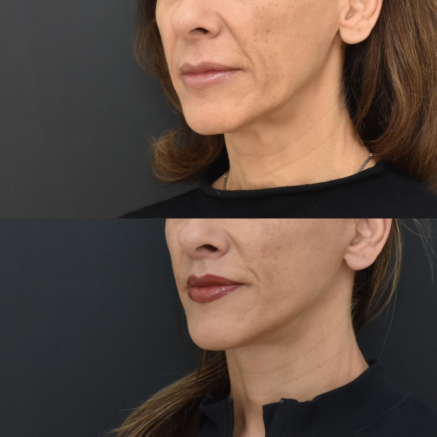 Lip Lift Before & After