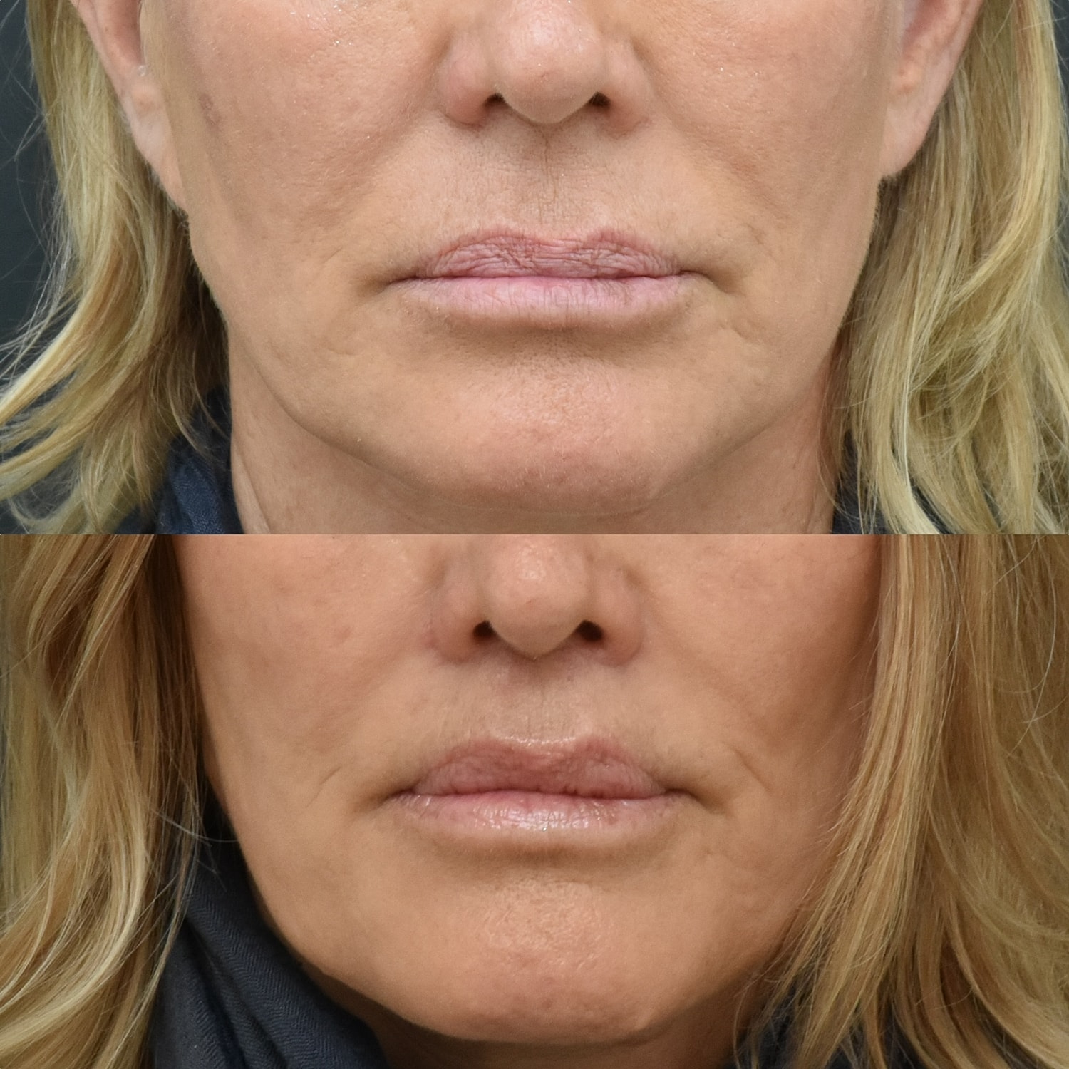 Lip Lift Before & After
