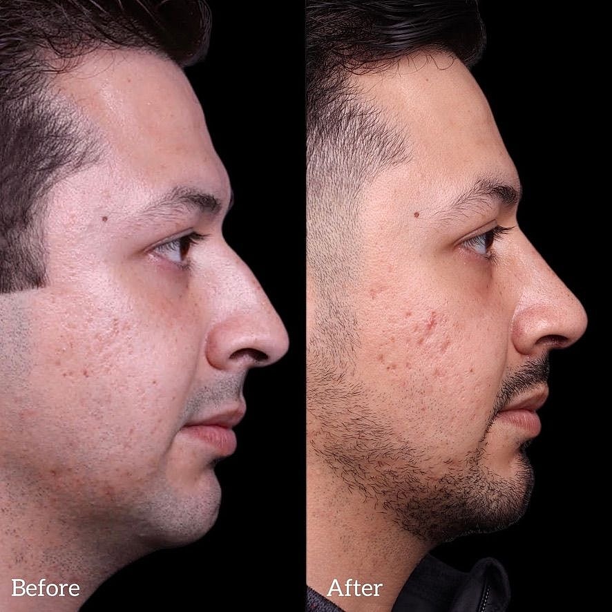 Rhinoplasty Before & After