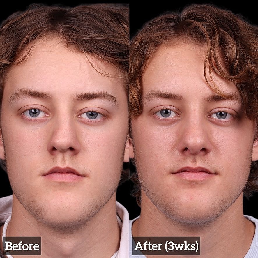 Rhinoplasty Before & After