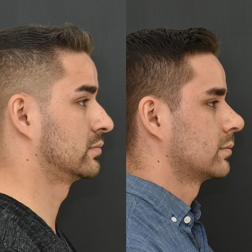 Rhinoplasty Before & After